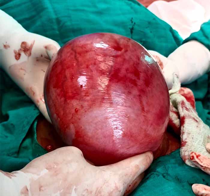 जिला चिकित्सालय दुर्ग में जशपुर की महिला का सफल ऑपरेशन: बच्चेदानी से 3 किलो का फाइब्राइड निकाला गया जिला चिकित्सालय दुर्ग में जशपुर की महिला का सफल ऑपरेशन: बच्चेदानी से 3 किलो का फाइब्राइड निकाला गया