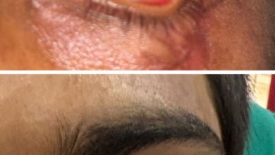 स्किन ग्राफ्टिंग से मरीज के पलक का सफल पुनर्निर्माण