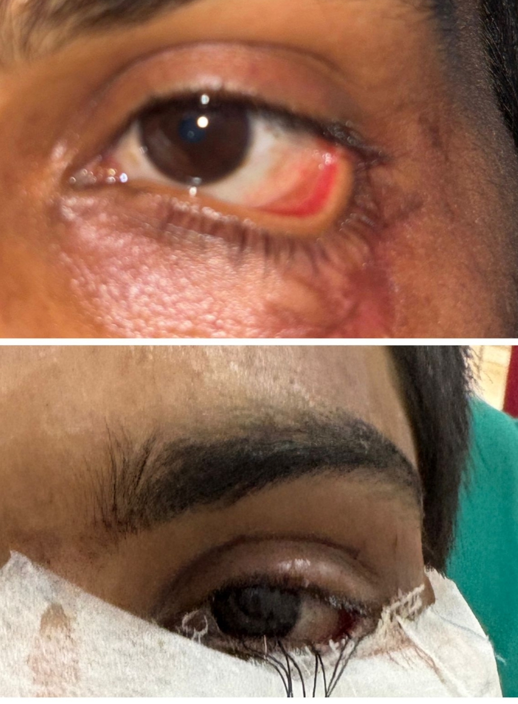 स्किन ग्राफ्टिंग से मरीज के पलक का सफल पुनर्निर्माण