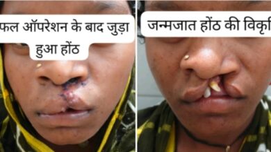 सफल सर्जरी से भीमे हेमला के चेहरे पर लौटी मुस्कान सफल सर्जरी से भीमे हेमला के चेहरे पर लौटी मुस्कान